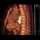 Ectopic pancreas, gigantic, pancreatic ectopia: NM - Nuclear medicine